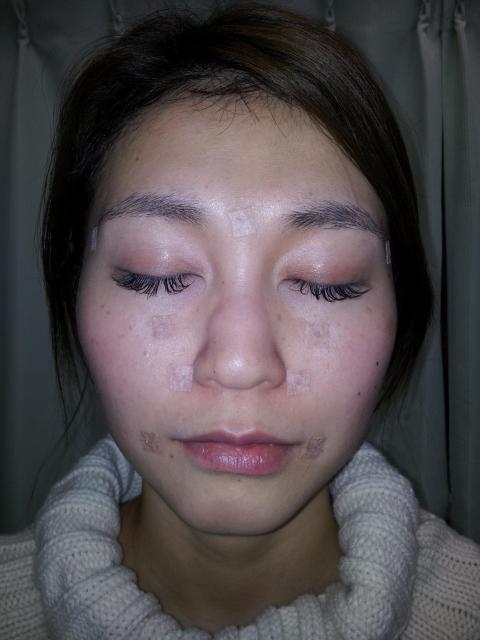 美容針